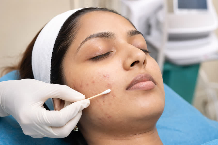Acne & Acne Scars